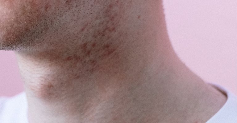 causas-acne-cuello