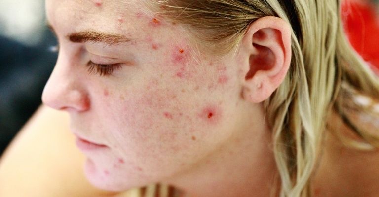 causas-acne-rostro-mejillas