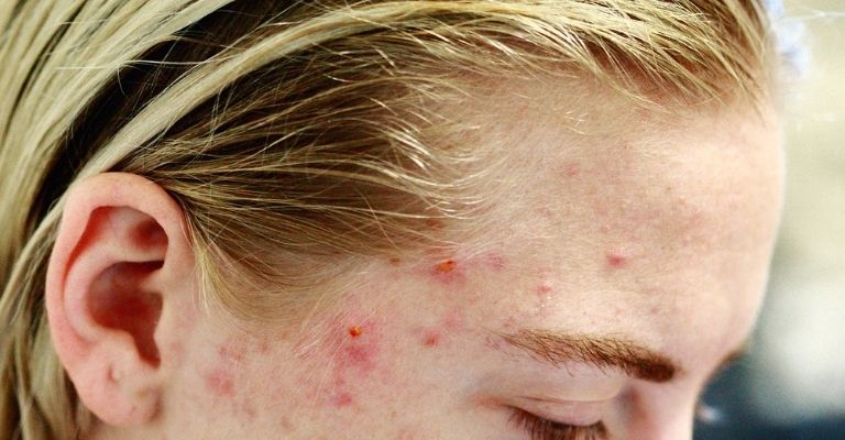 causas-acne-rostro-sienes